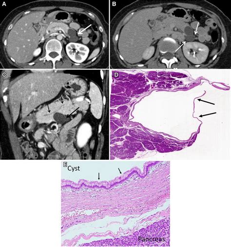 In the uk, there is no screening programme for pancreatic cancer that is available for everyone. A 41-year-old female with MNNC in the pancreatic tail. A ...