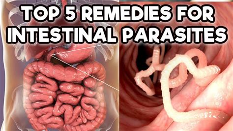 intestinal worms top 5 natural remedies for intestinal parasites youtube