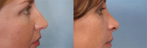 Rhinoplasty Nose Reshaping Before And After Pictures Case 128