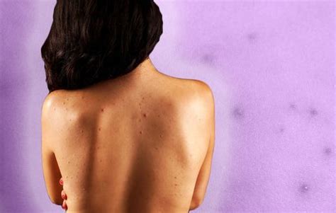 But if you know how to pop a pimple and when, it can work. Back Acne: Dr. Pimple Popper Shares How To Treat | Women's ...