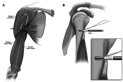 A Surgical Incision And Anatomic Approach For Subpectoral Biceps