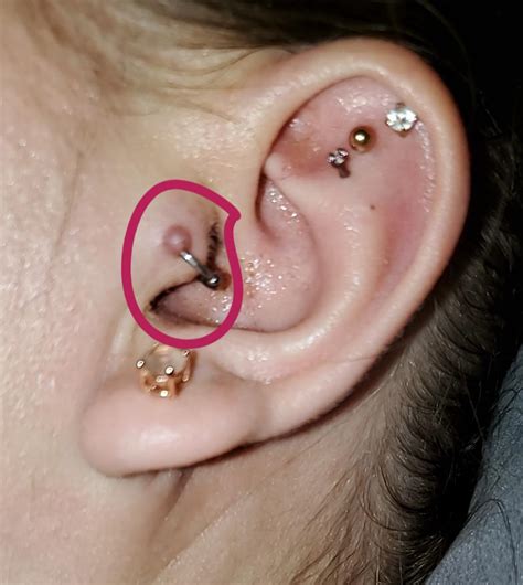 Is This A Keloid Or Hypertrophic Scar What Should I Do Regarding That Piercing