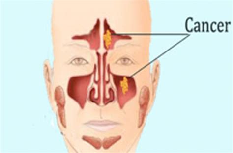 Sinus Cancer