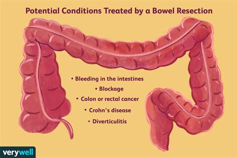 Bowel Resection Surgery Purpose Recovery And More