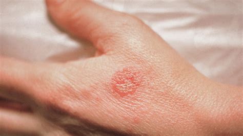 Circle Rashes On The Skin But Not Ringworm Other Causes