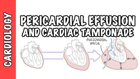 Cardiac Tamponade Pericardial Effusion Causes Pathophysiology