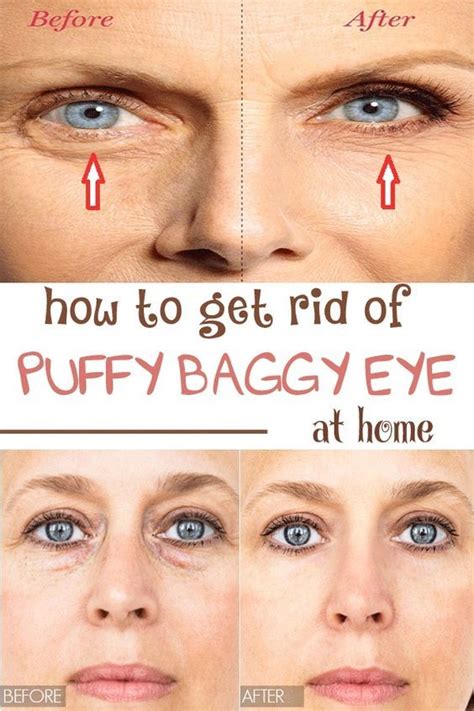 Diy How To Get Rid Of Puffy Baggy Eye At Home Baggy Eyes Puffy Eyes