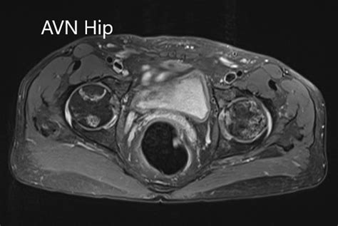 Case Study Bilateral Total Hip Replacement In 58 Yr Old Male