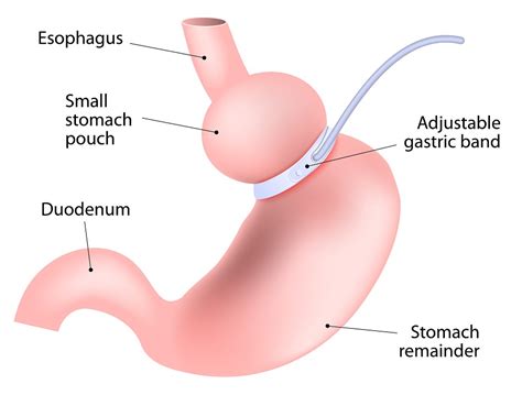Gastric Banding Is A Weight Loss Band Right For You
