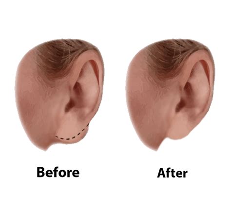 Ear And Earlobe Surgery Visage Facial Plastic Surgery