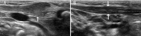 A A Vertical Section Of The Sternocleidomastoid Muscle Scm In A