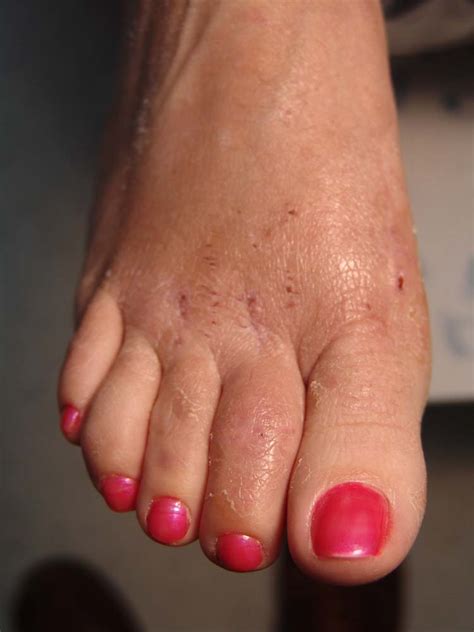 Allergic Contact Dermatitis Of The Foot After Use Of Mastisol® Skin