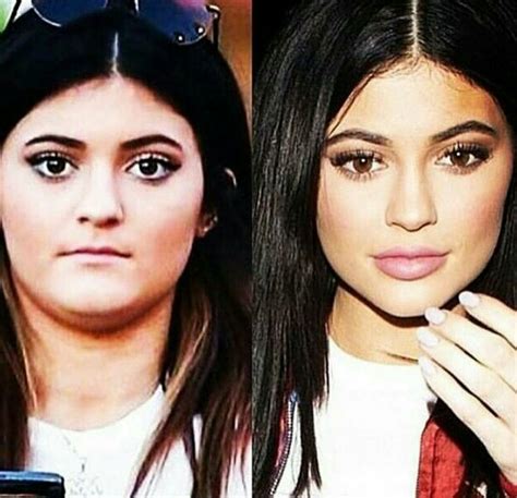Kylie Jenner Ugly Kylie Jenner Plastic Surgery Celebrity Surgery