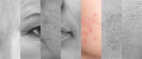 Acne And Blemishes Skinfitnesstherapy