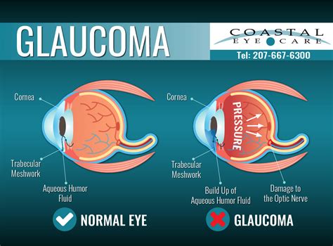 Glaucoma Diagnosis And Treatment For Bangor Me Coastal Eye Care