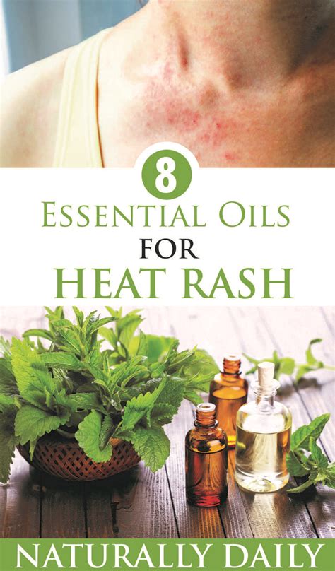 8 Best Essential Oils For Heat Rash Quick Natural Remedies Heat Rash