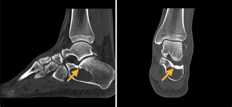 Unicameral Bone Cyst Of The Calcaneus Journal Of Orthopaedic And Sports