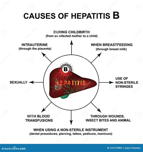 Causas De La Hepatitis B Da De La Hepatitis Del Mundo Infografa Ejemplo Del Vector En Fondo