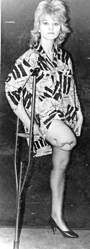 1960s Sak Amputee Girl Jackcast2015 Flickr