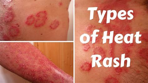 Types Of Heat Rash Heat Rash Types Of Rashes Dry Skin On Face