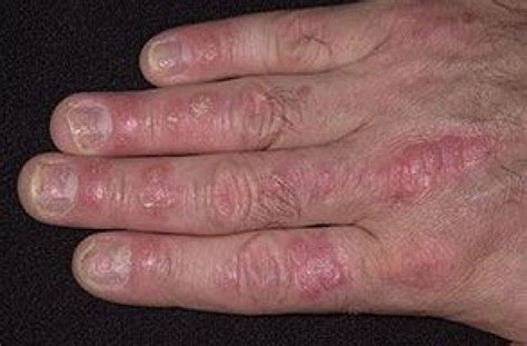 Psoriasis Types And Symptoms Psoriasis Treatment Psoriasis Rash