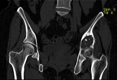 Surgical removal is the standard treatment, but chemotherapy and radiation therapy also be. (a) CT image showing the tumor inside pelvic bone, (b ...