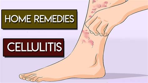 Cellulitis Infection Control