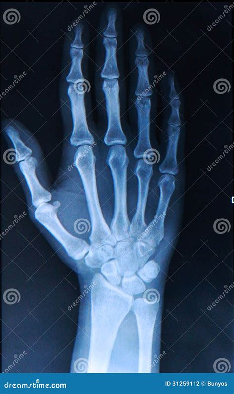 Xray Of Hand Fingers Stock Photo Image Of Medical Break 31259112