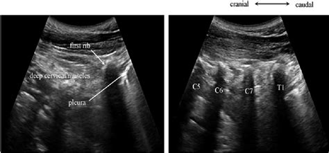 Demonstration The Step Of Us Ps To Identify C7 Transverse Process