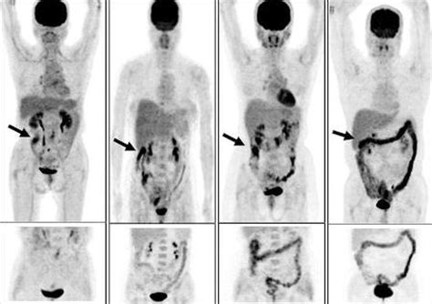 Should i get screened for colon cancer? PET/CT with laxative contrast tops PET in colorectal cancer