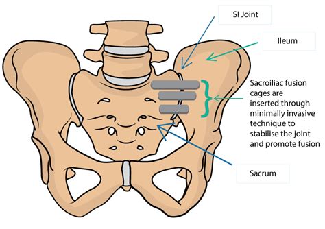 Minimally Invasive Sacroiliac Joint Fusion At Insight Neurosurgery Hot Sex Picture