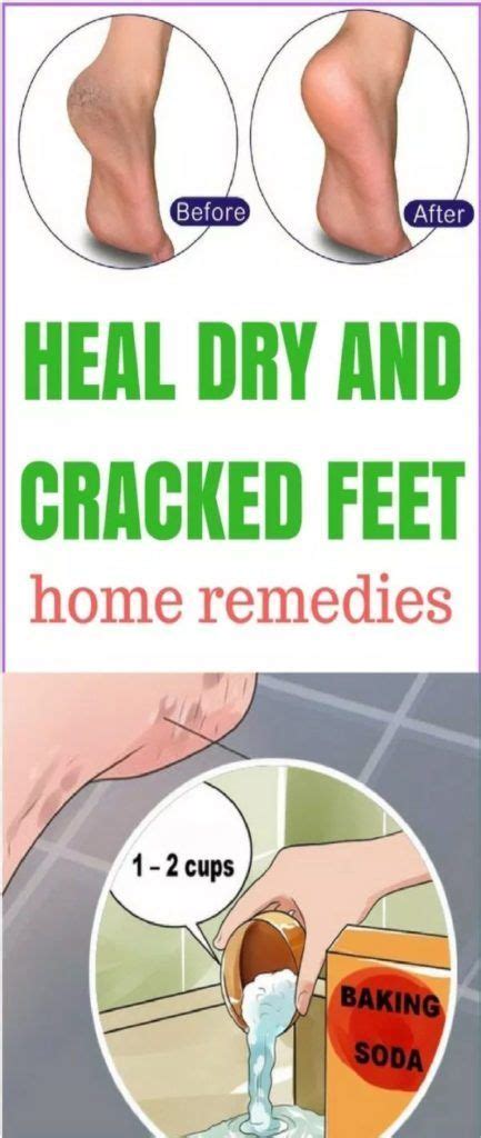 Heal Dry And Cracked Feet Home Remedies Healthy Beauty Ways Cracked Feet Dry Cracked Feet