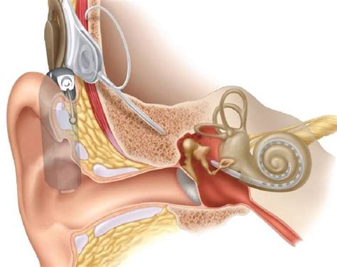 Cochlear Implant The Bionic Ear St Vincents ENT
