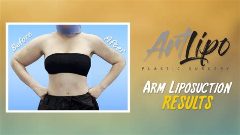Arm Liposuction Immediate Results Celebrity Arms Lipo
