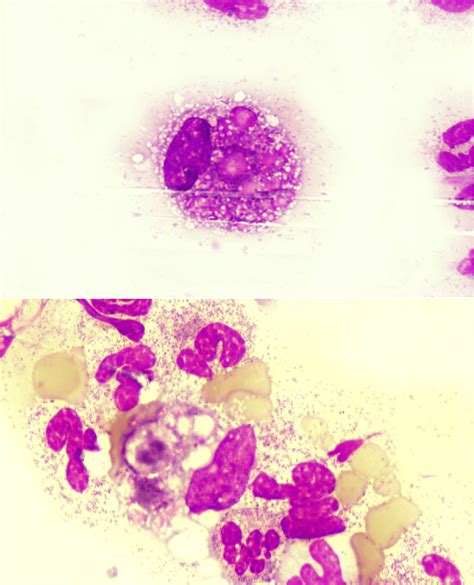 Cureus An Unusual Case Of Phagocytic Histiocytes On Peripheral Blood