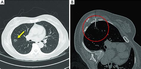 Pulmonary Nodules In Lungs