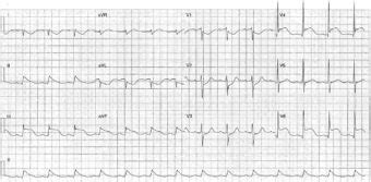 Ecg Case Litfl Ecg Top Self Assessment Quiz