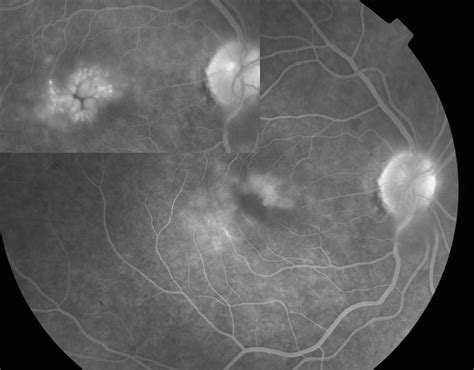 The Effect Of Pars Plana Vitrectomy On Cystoid Macular Oedema