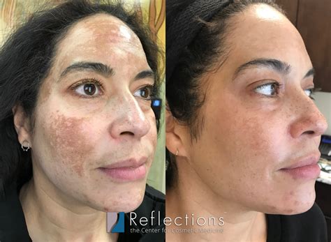 Stubborn Melasma Treated With Oral Tranexamic Acid Prescription Before