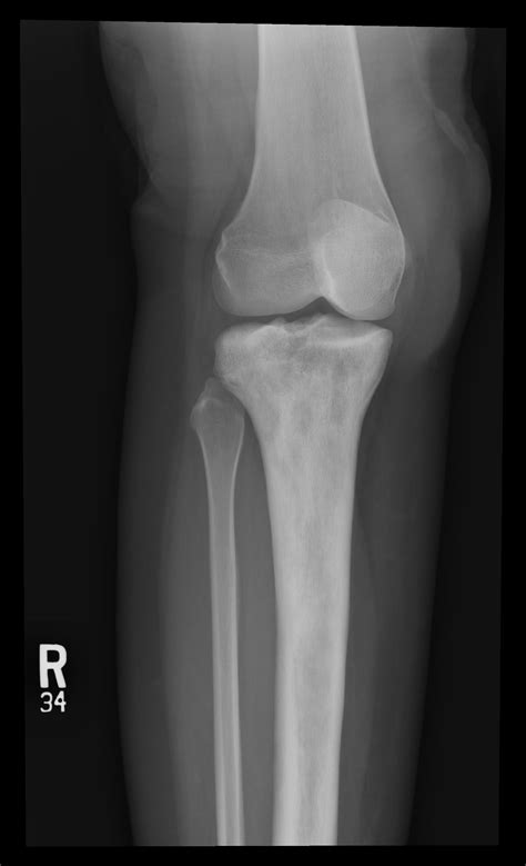 Primary Bone Lymphoma Image