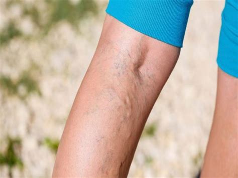 Top 10 Varicose Vein Myths Busted Comprehensive Vein Care