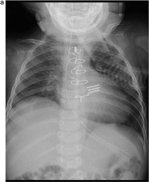 Case 3 An 11 Month Old Male With Right Diaphragmatic Paralysis Chest