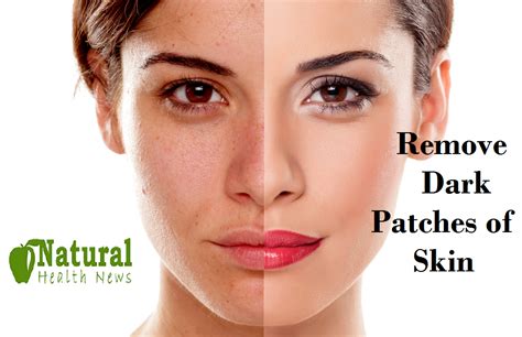 8 Tips To Remove Dark Patches Of Skin Natural Health News