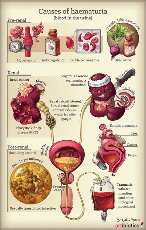 Causes Of Blood In The Urine Haematuria Rmedizzy