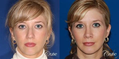 Chin Augmentation Before And After Gallery Patient 13
