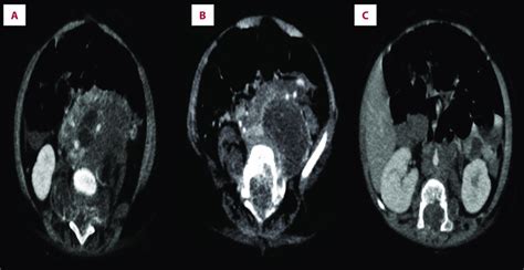 A Contrast Enhanced Axial Computed Tomography Shows A Heterogeneously