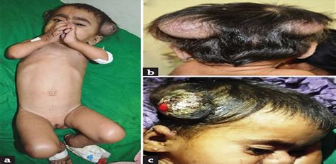 Hyaline Fibromatosis Syndrome A Rare Inherited Disorder Indian