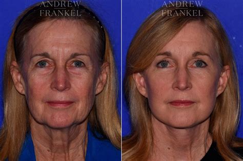 Facial Rejuvenation Before And After Photos Andrew S Frankel Md
