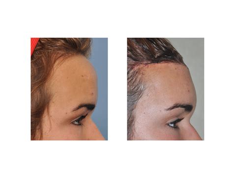 Case Study Reduction Of The Long Forehead And Frontal Bossing