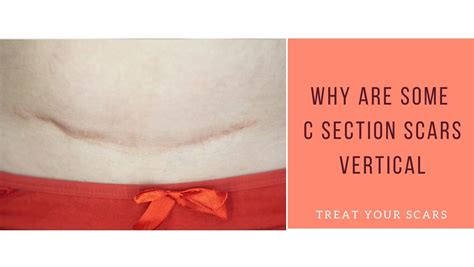 Why Are Some C Section Scars Vertical Treat Your Scars